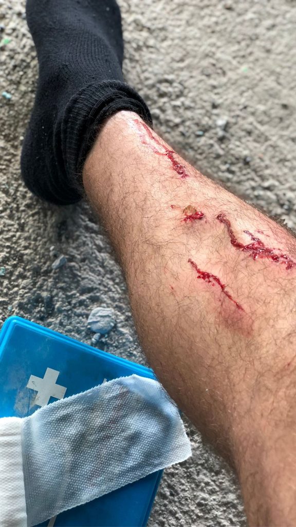 noha poranenie_hemofilia_ ilustracne foto