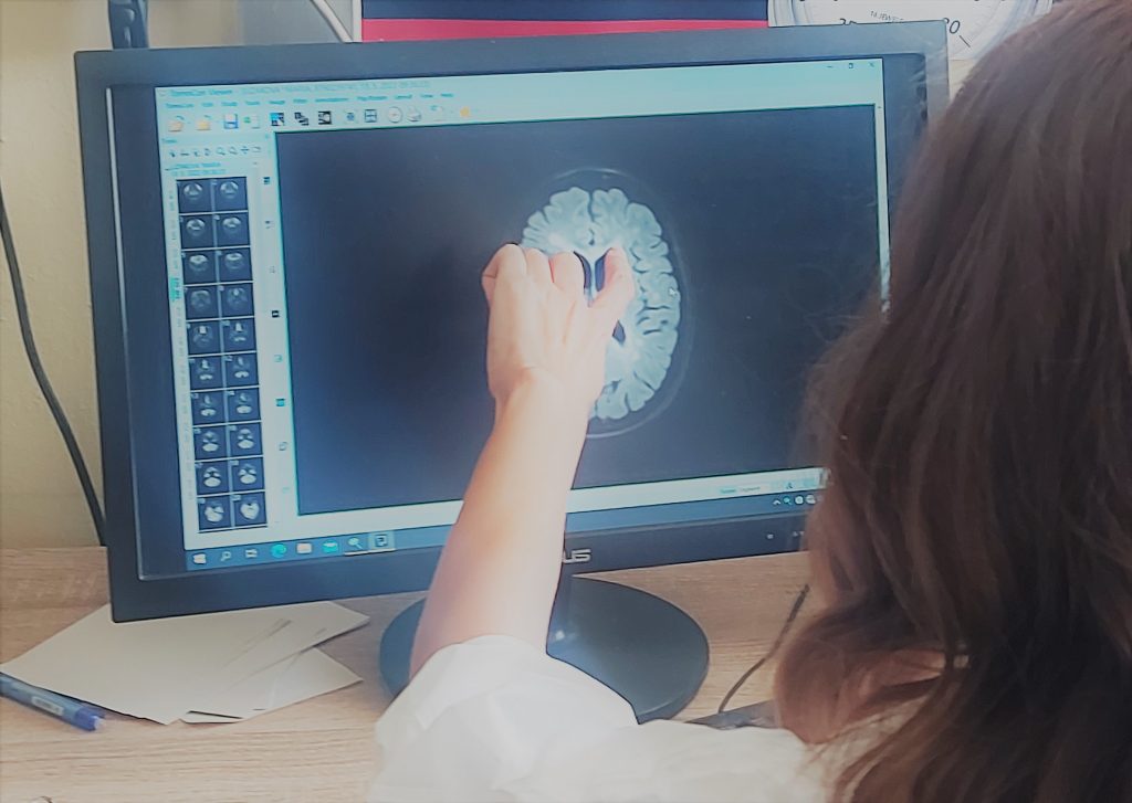 skleroza multiplex_ ilustracna fotografia